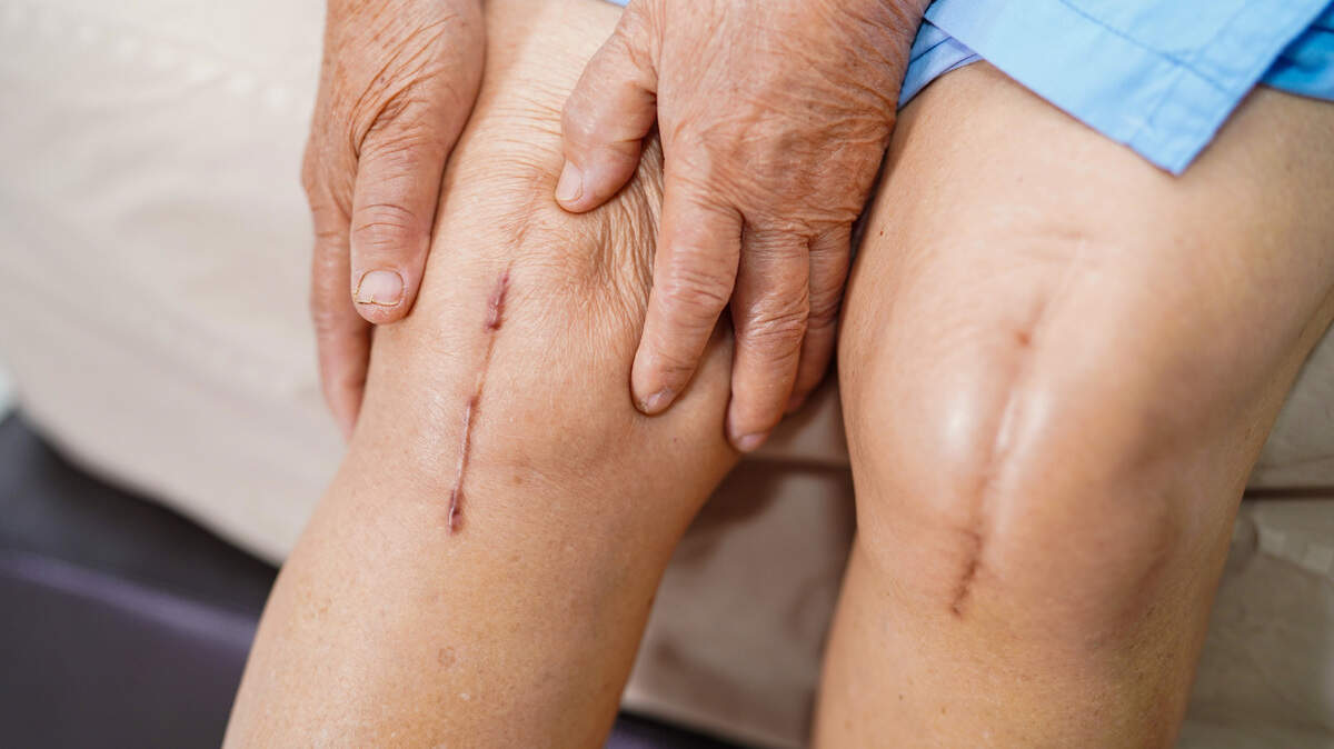 Los procedimientos articulares no suelen ser emergencias, y fueron de los primeros en ser eliminados o retrasados cuando los hospitales suspendieron las cirugías electivas en marzo, y de nuevo en julio en áreas plagadas de nuevos brotes de COVID.