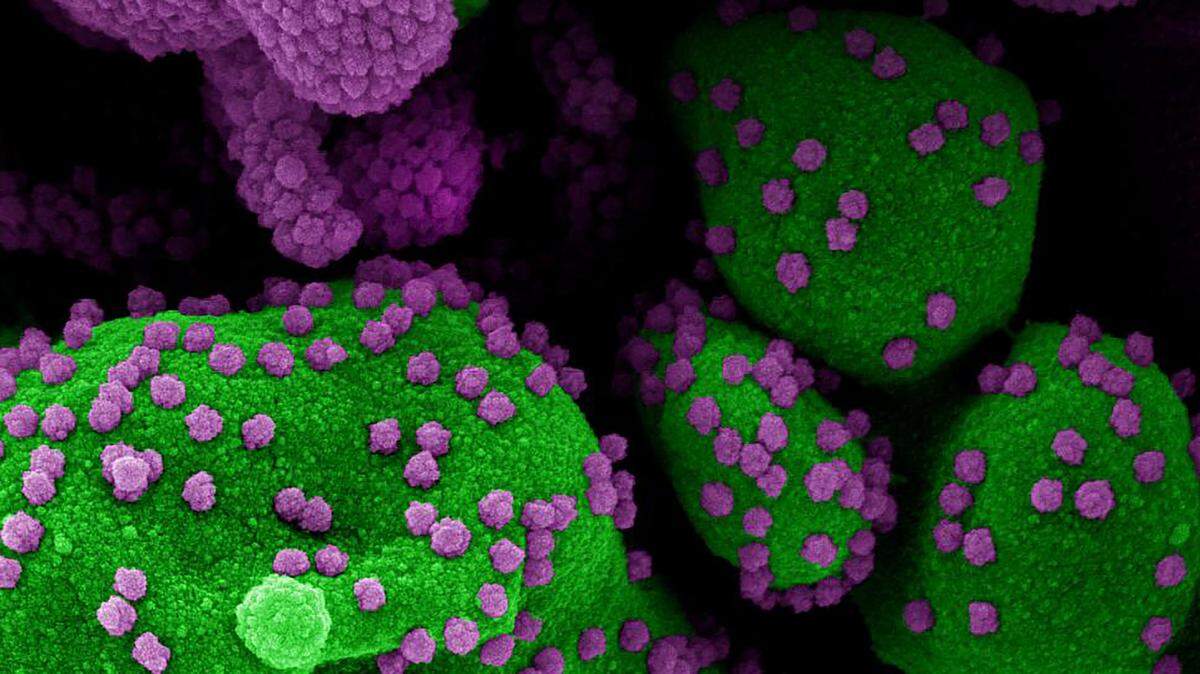 Una micrografía electrónica de una célula apoptótica muy infectada con partículas de coronavirus.