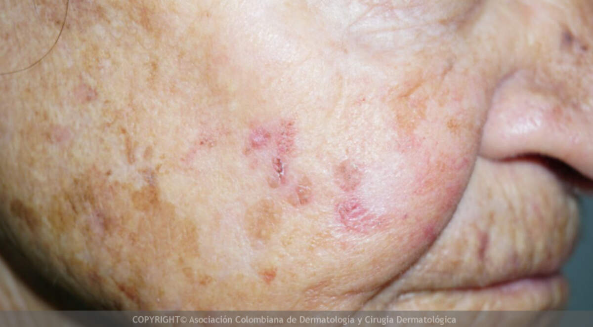 Las manchas rojizas o ásperas en la piel se llaman, en términos médicos, queratosis actínicas. Como son resultado de la exposición prolongada al sol, suelen aparecer en el rostro, el cuero cabelludo, los antebrazos y el dorso de las manos.