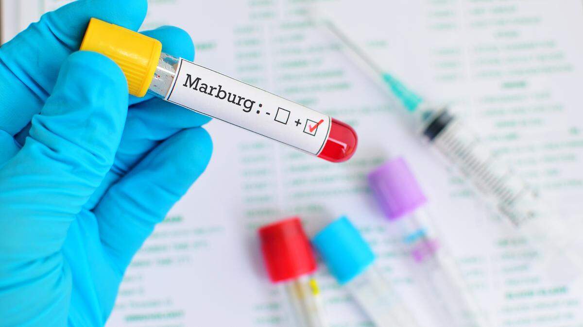 Muestra de sangre positiva con virus de Marburgo.