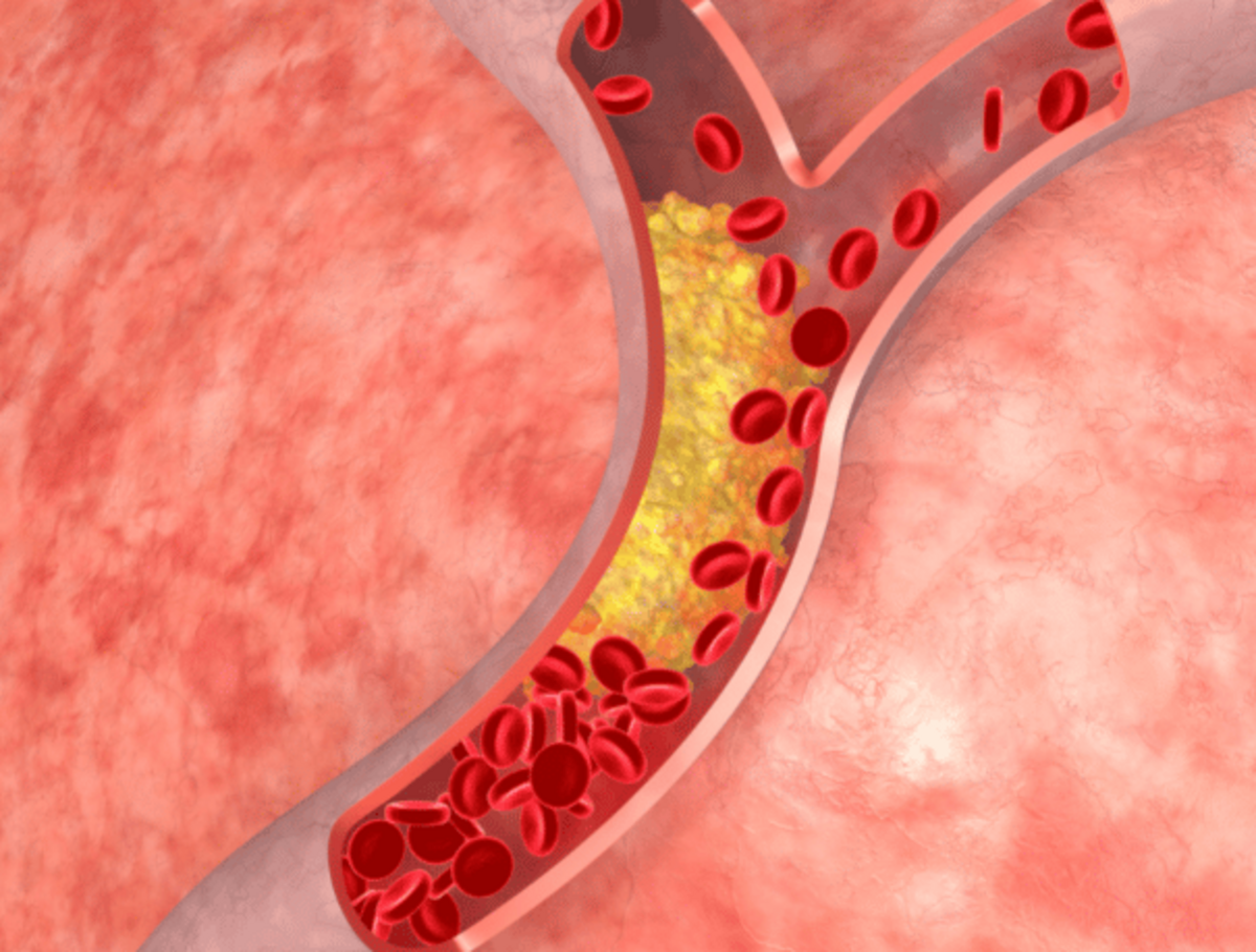El  escáner de calcio es una de las técnicas diagnósticas más eficaces para evaluar el riesgo cardiovascular que presenta una persona, es decir, la posibilidad de desarrollar una patología coronaria o sufrir un ataque cardíaco.