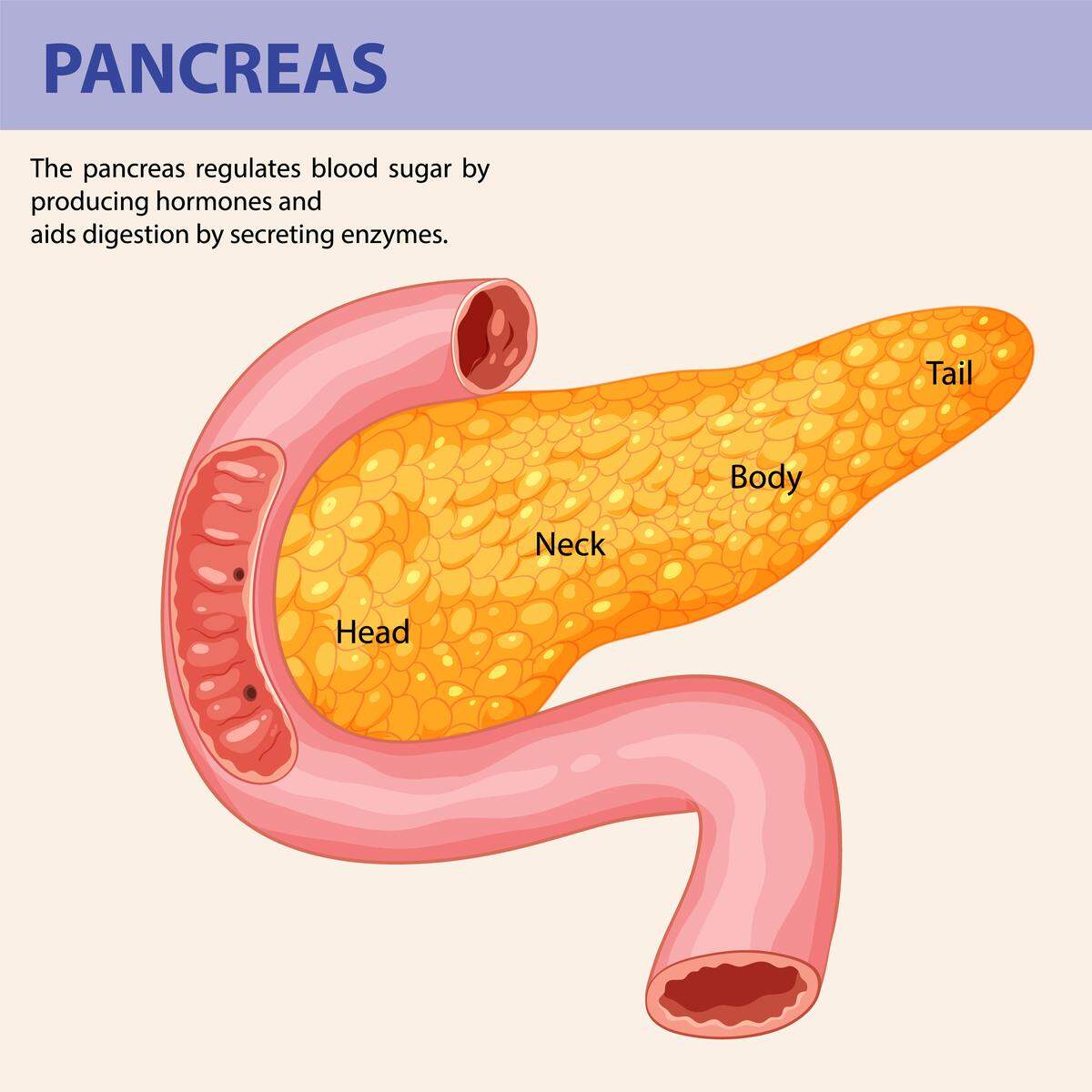 Lo más habitual es que el cáncer se origine en la región del páncreas llamada cabeza (60% de los casos), pero también puede surgir en la zona conocida como cuerpo o cola del páncreas.