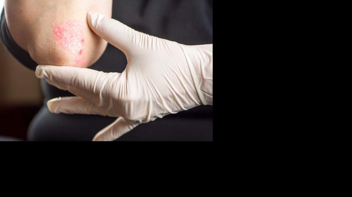 La psoriasis afecta al 3 por ciento de la población mundial. ThinkstockPhotos