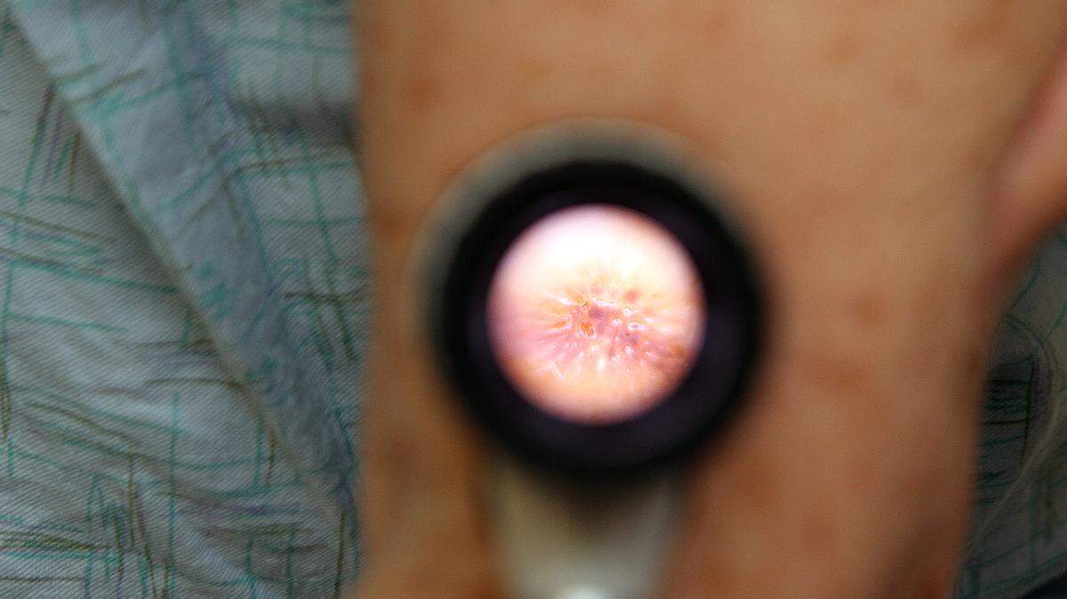 A skin mole can sometimes look like melanoma or other skin cancers. Moles should be watched closely to see if they grow and become cancerous. They are different from freckles.