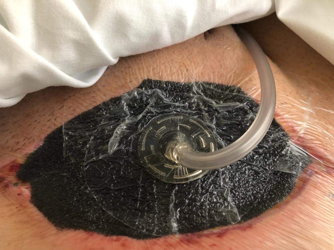 The skin around Stephanie O'Brien's stomach began to turn black after cosmetic surgery.