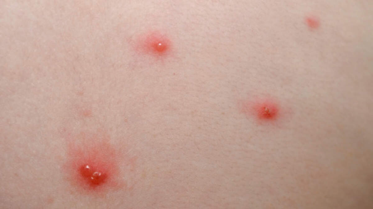 Chickenpox detail.