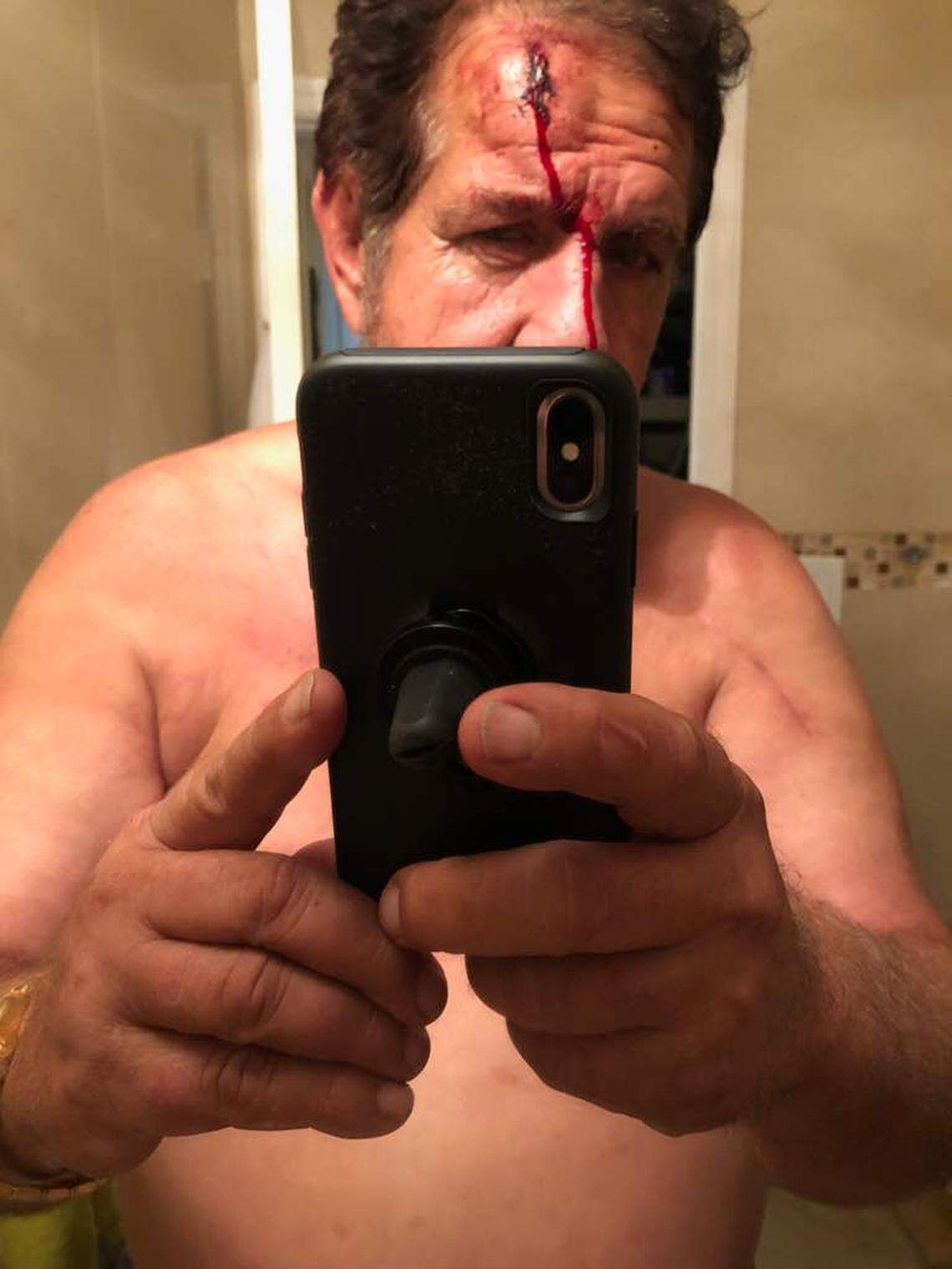 Evelio Gainza, 63, was murdered by his own daughter in September 2018, according to Miami-Dade police. He is pictured here after she allegedly attacked him with a baseball bat months earlier.