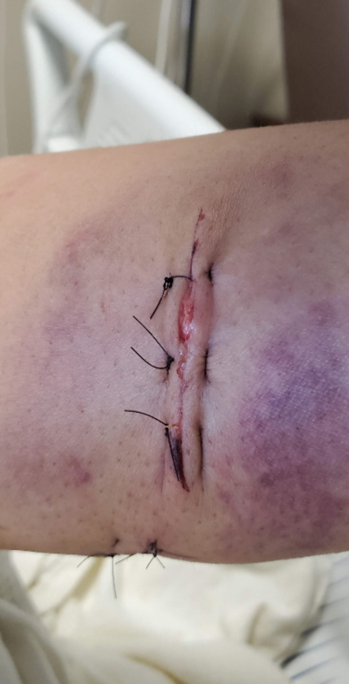 Bates tomó esta foto de su antebrazo izquierdo después de la cirugía.