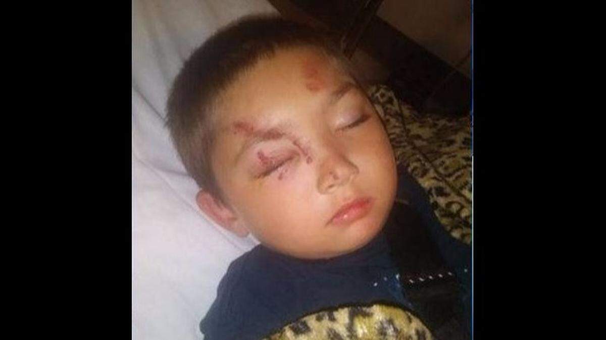 Ninño de 6 años de Washington dijo que sus heridas fueron el producto de una paliza de niños abusadores, dijo la madre a los medios.