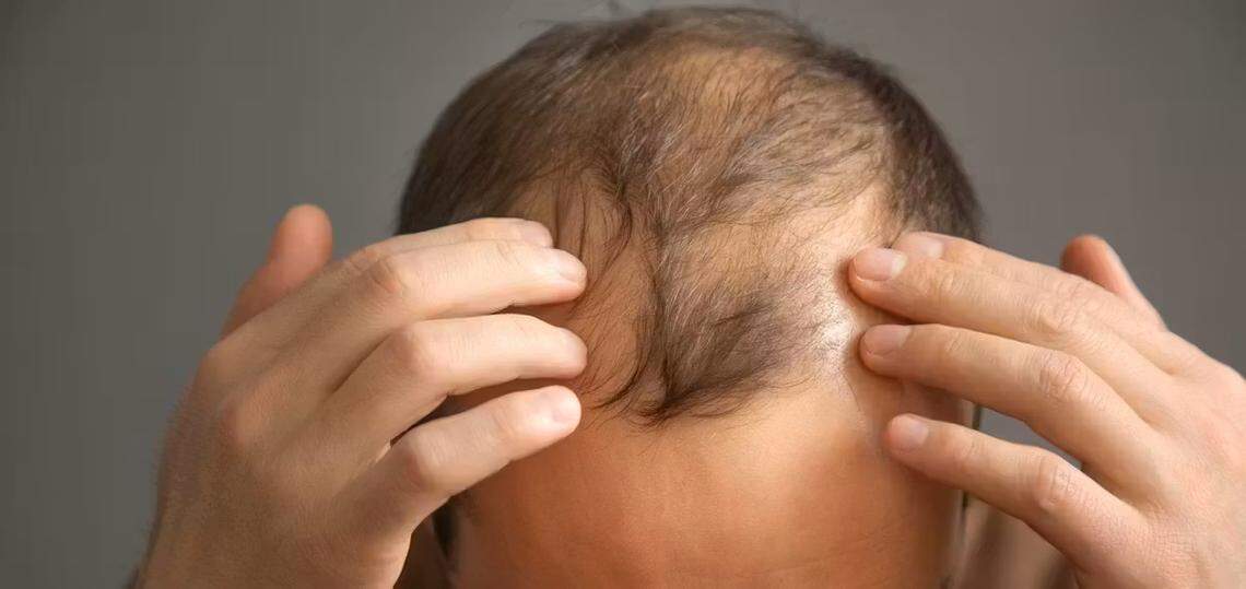 Dentro de unos años la regeneración capilar ya no pertenecerá al terreno de la ciencia ficción, sino al de la medicina regenerativa.