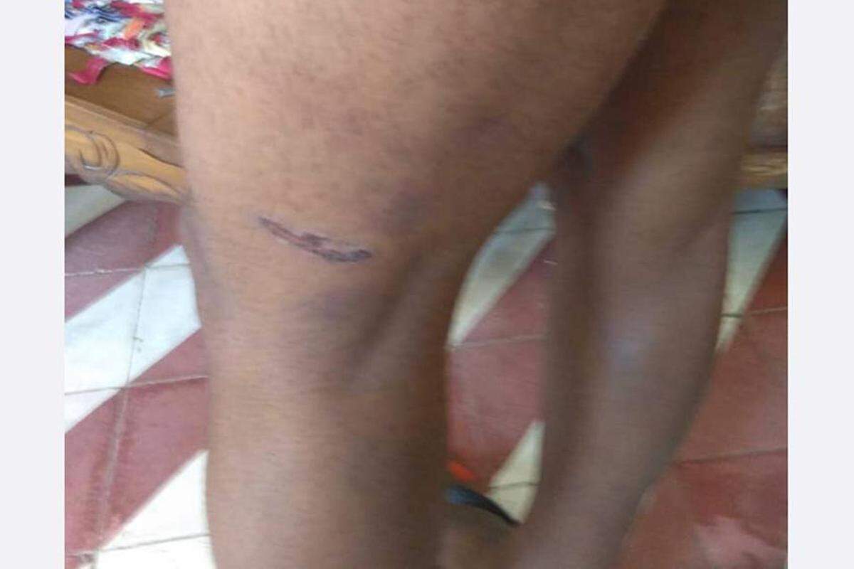 Ibrahim Domínguez Aguilar muestras las heridas provocadas por la Policía durante su arresto el pasado 25 de diciembre en el oriente de Cuba.