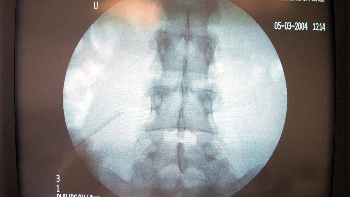 La Medicina Regenerativa regenera y repara problemas serios de la columna.