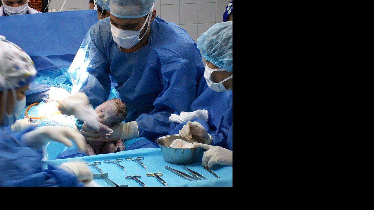 Recién nacido obtenido por cesárea, cordón umbilical aún intacto. Maracay, Venezuela.