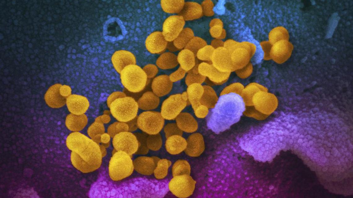 This electron microscope image made available by the U.S. National Institutes of Health shows the Novel Coronavirus SARS-CoV-2, yellow, emerging from the surface of cells, blue/pink, cultured in the lab.