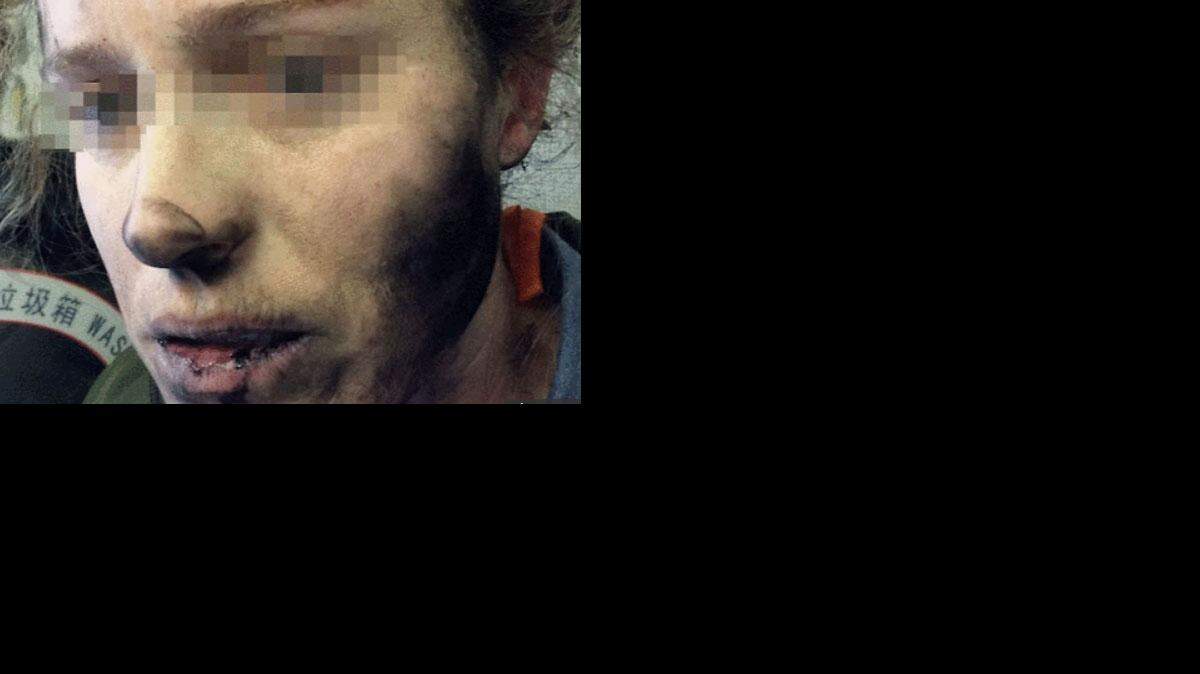 Las imágenes muestran que la víctima quedó con la cara y con el cuello ennegrecidos y con ampollas en las manos.