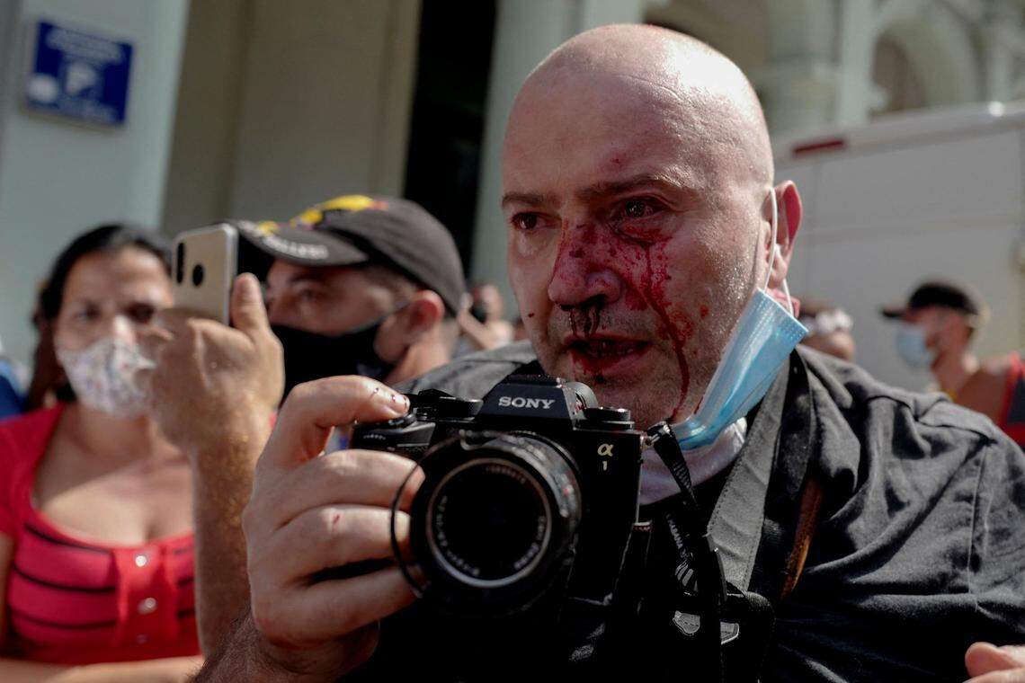 El fotógrafo de la Associated Press Ramon Espinosa sufrió lesiones y fue arrestado por la policía mientras cubría la protesta en La Habana, Cuba. El domingo 11 de julio miles de cubanos salieron a las calles de toda la isla a protestar.