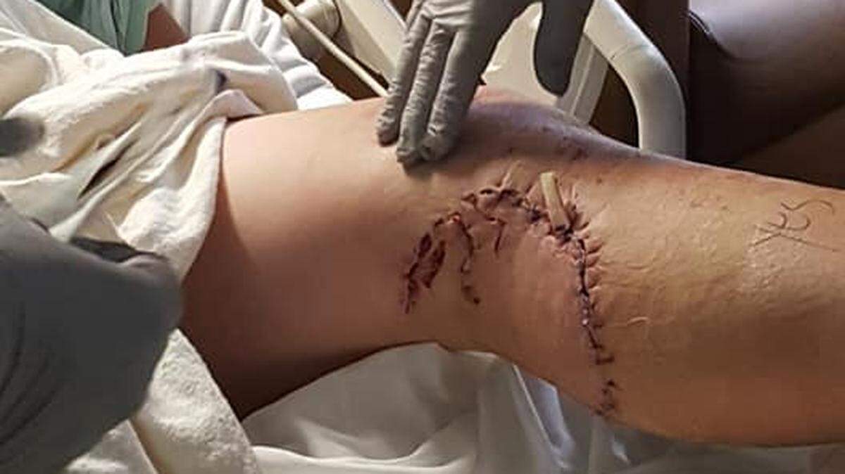 Cody High, de 15 años, se recupera de una supuesta mordida de un tiburón en su pierna izquierda, mientras disfrutaba con su familia en una playa del sur de la Florida.