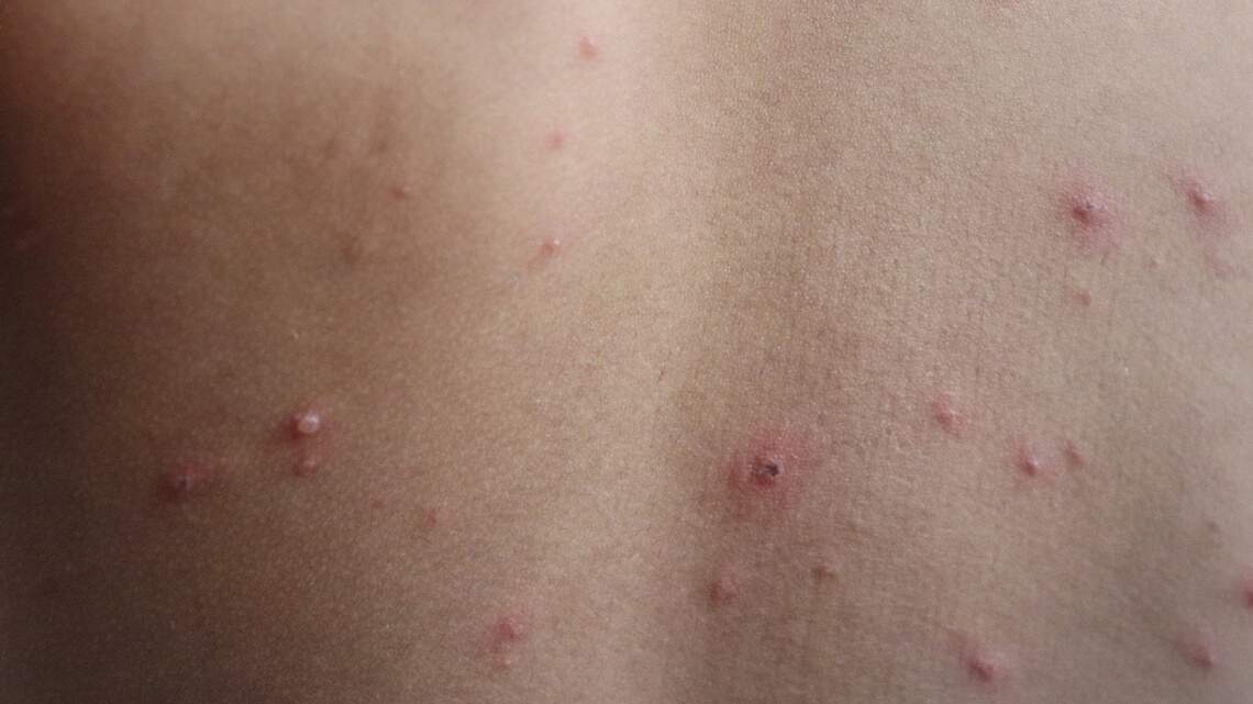 An unvaccinated child was diagnosed with measles in Eastern Idaho. What we know