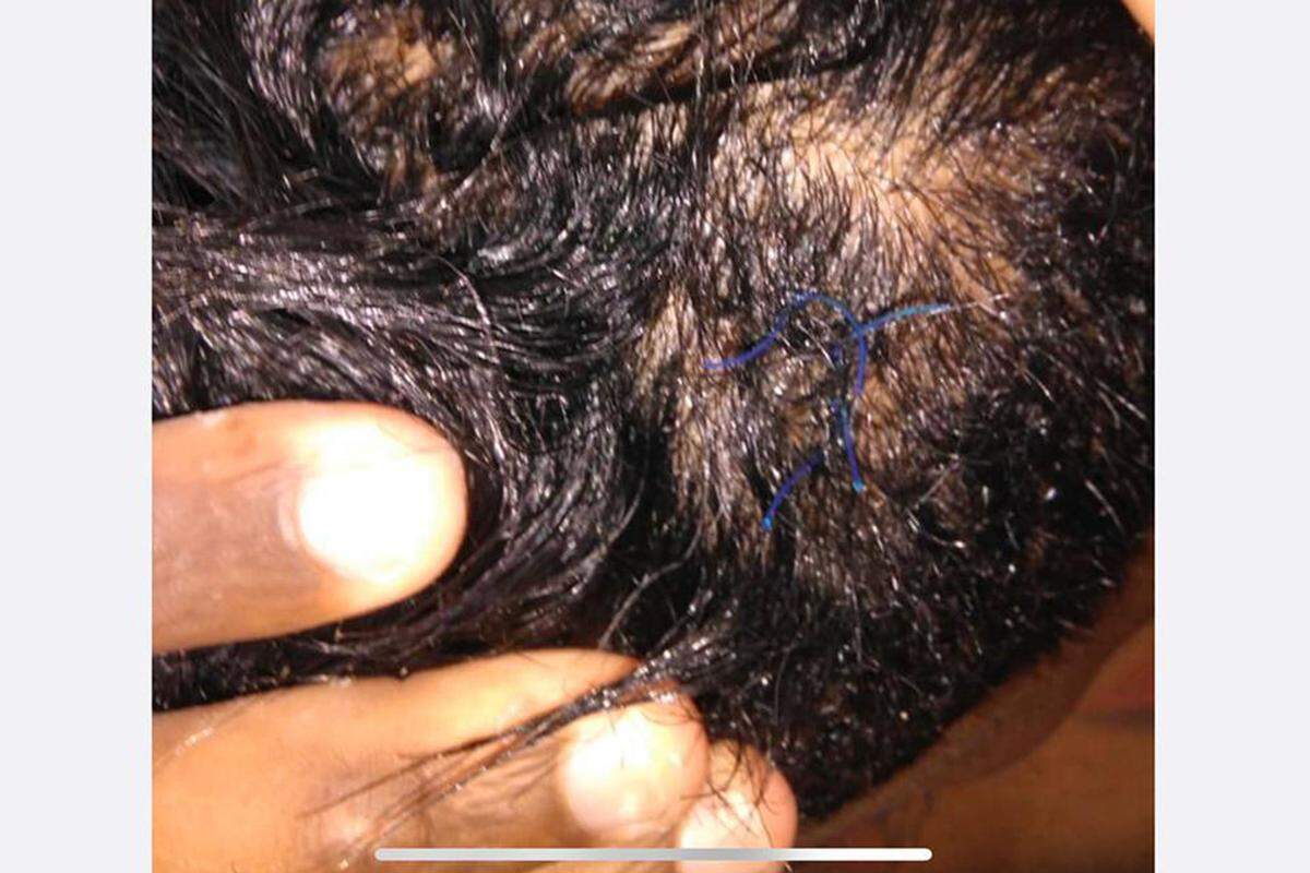 Ibrahim Domínguez Aguilar muestras las heridas provocadas por la Policía durante su arresto el pasado 25 de diciembre en el oriente de Cuba.