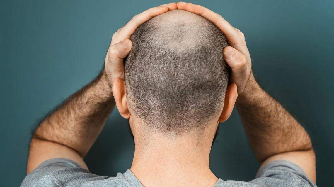 La terapia celular abre una nueva vía para acabar con la calvicie