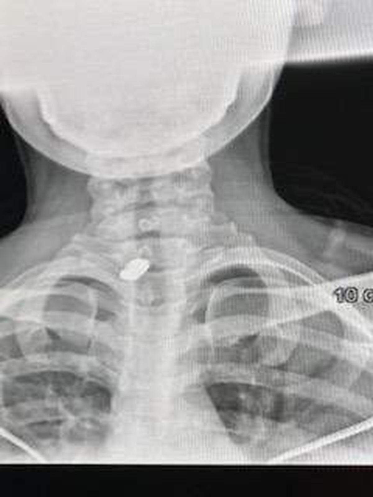 Una radiografía muestra una bala alojada en el cuello de Esha Dawkins, quien recibió un disparo mientras conducía por la Interestatal 95 el lunes 25 de noviembre de 2024.
