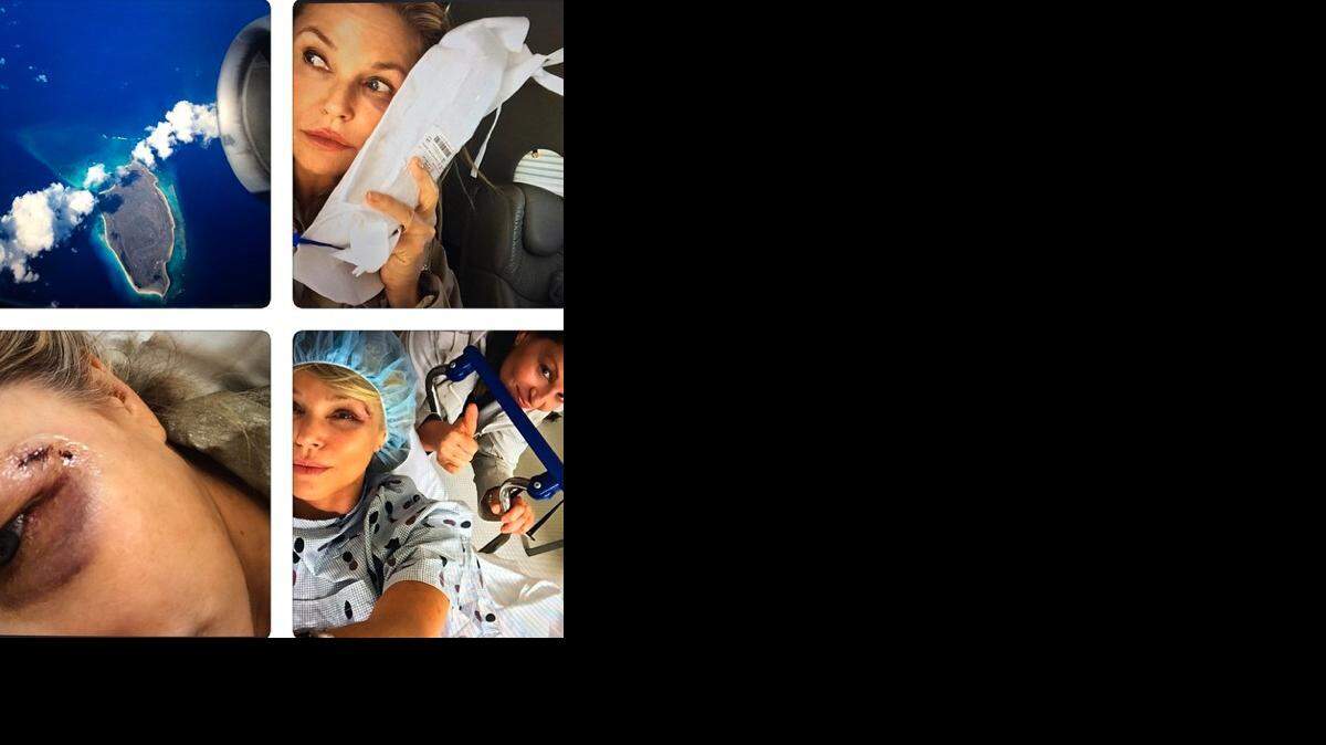 La modelo, que no detalla cómo fue el accidente, publicó en Instagram fotos en las que se observa una sutura cerca de la ceja.