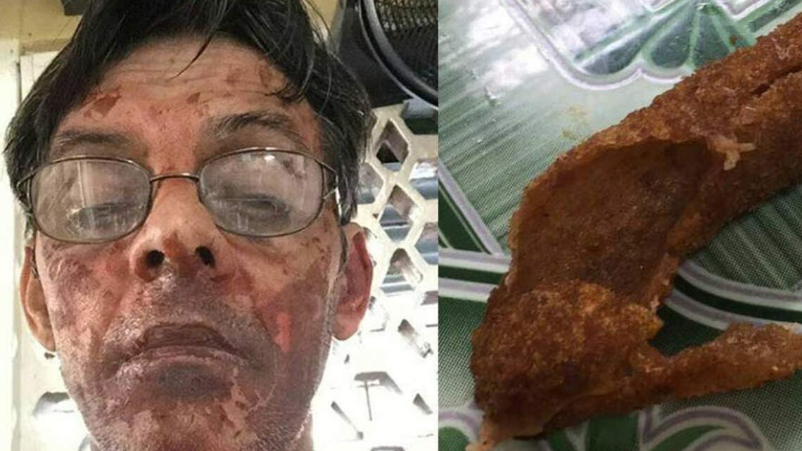 Nuevo terror de las cocinas en Cuba. Croquetas explosivas han causado varias quemaduras