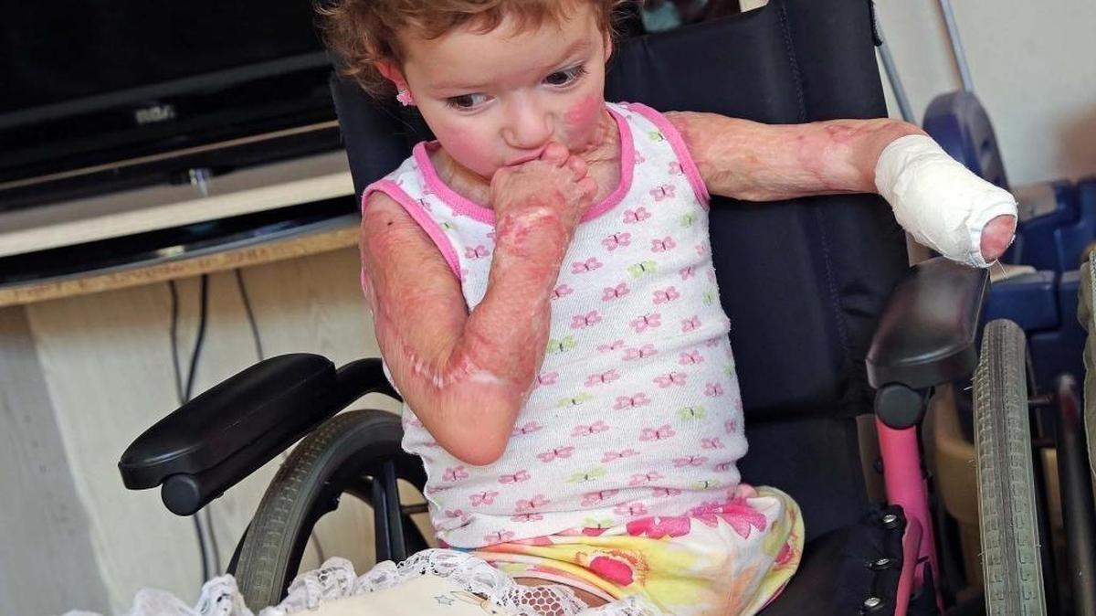 Samantha González, de 3 años, tiene quemado el 60 por ciento del cuerpo.