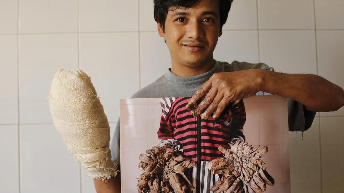 El joven conocido como ‘hombre árbol’ de Bangladesh, Abul Bajandar, muestra una fotografía de cómo estaban sus manos antes de someterse a 16 operaciones en el Dacca Medical College en Bangladesh el 9 de enero de 2017.