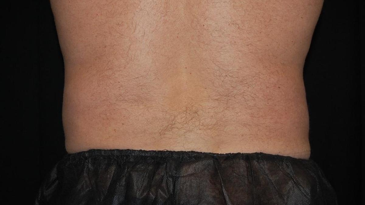 Después: no más rollos después de hacerse el tratamiento de CoolSculpting, una máquina que congela y mata las células de grasa.