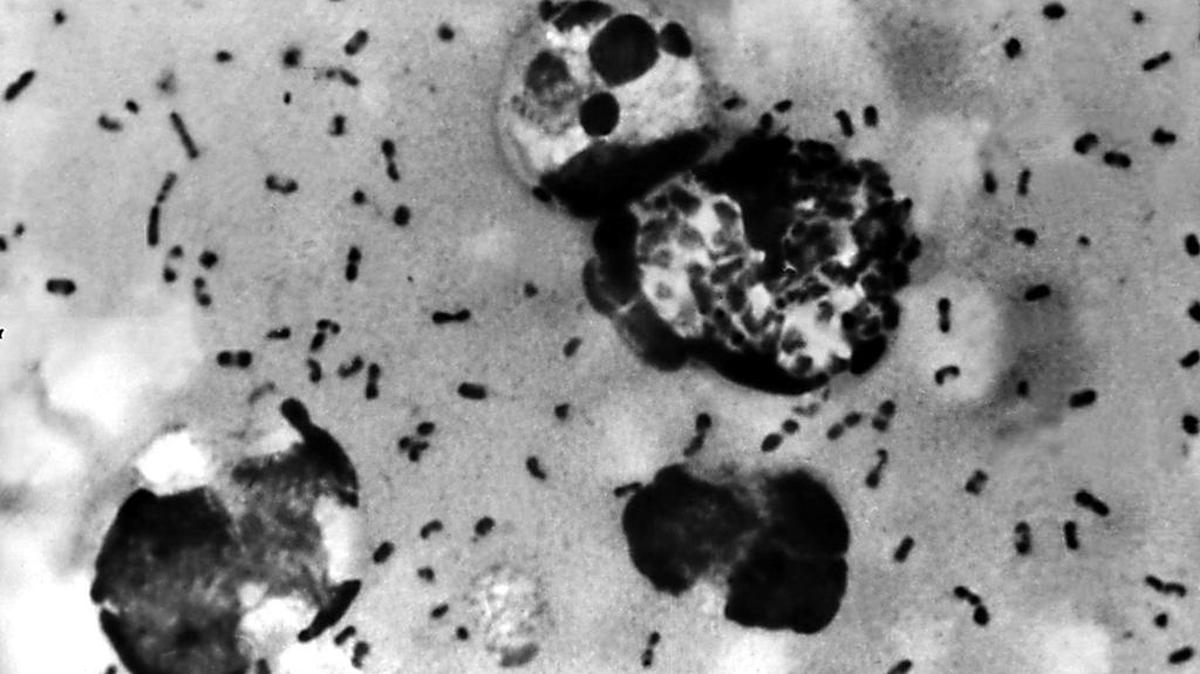 Un frotis de peste bubónica, preparado a partir de linfa extraída de un ganglio linfático adenopático de un paciente, demuestra la presencia de la bacteria Yersinia pestis.