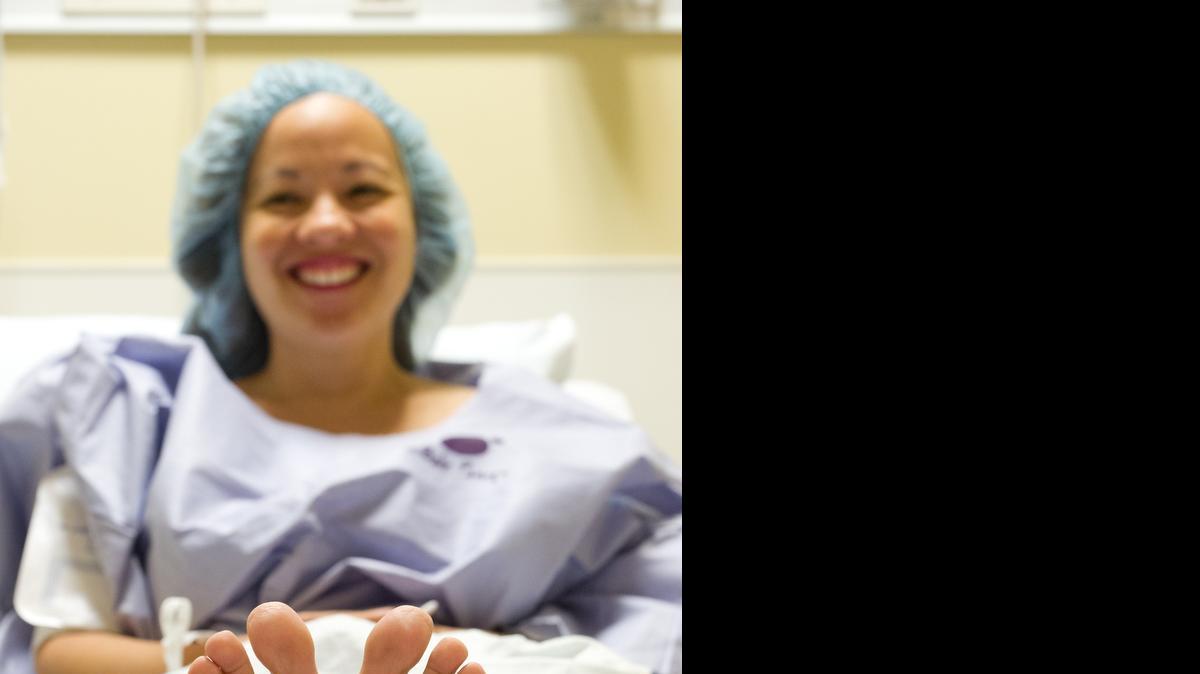 
Madeline Barrios antes de la cirugía en el Jackson South Hospital para quitarle los juanetes. Su condición era muy severa aunque ella no siempre usaba tacones. También tenía una predisposición genética a la condición, su madre tenía uno.


