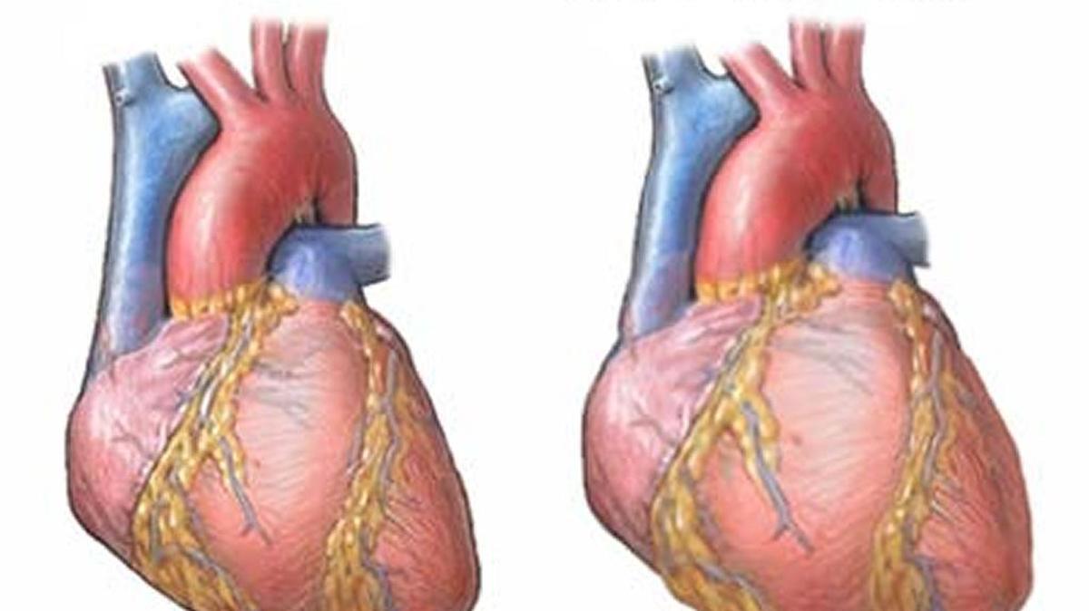 La gravedad de la miocarditis depende de la extensión de la inflamación.