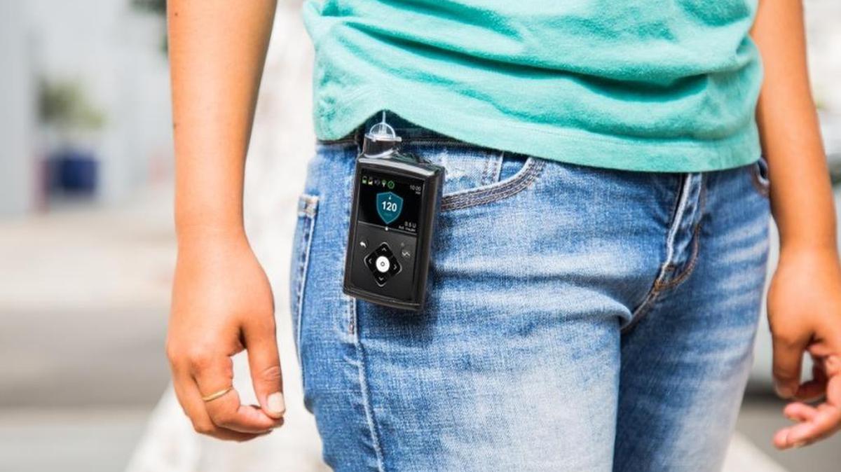 El Medtronic MiniMed 670G, recientemente aprobado por la FDA para diabeticos tipo 1 de 14 años y mayores. Estará en el mercado en abril del 2017. El aparato vigila los niveles de glucosa y administra insulina automáticamente.