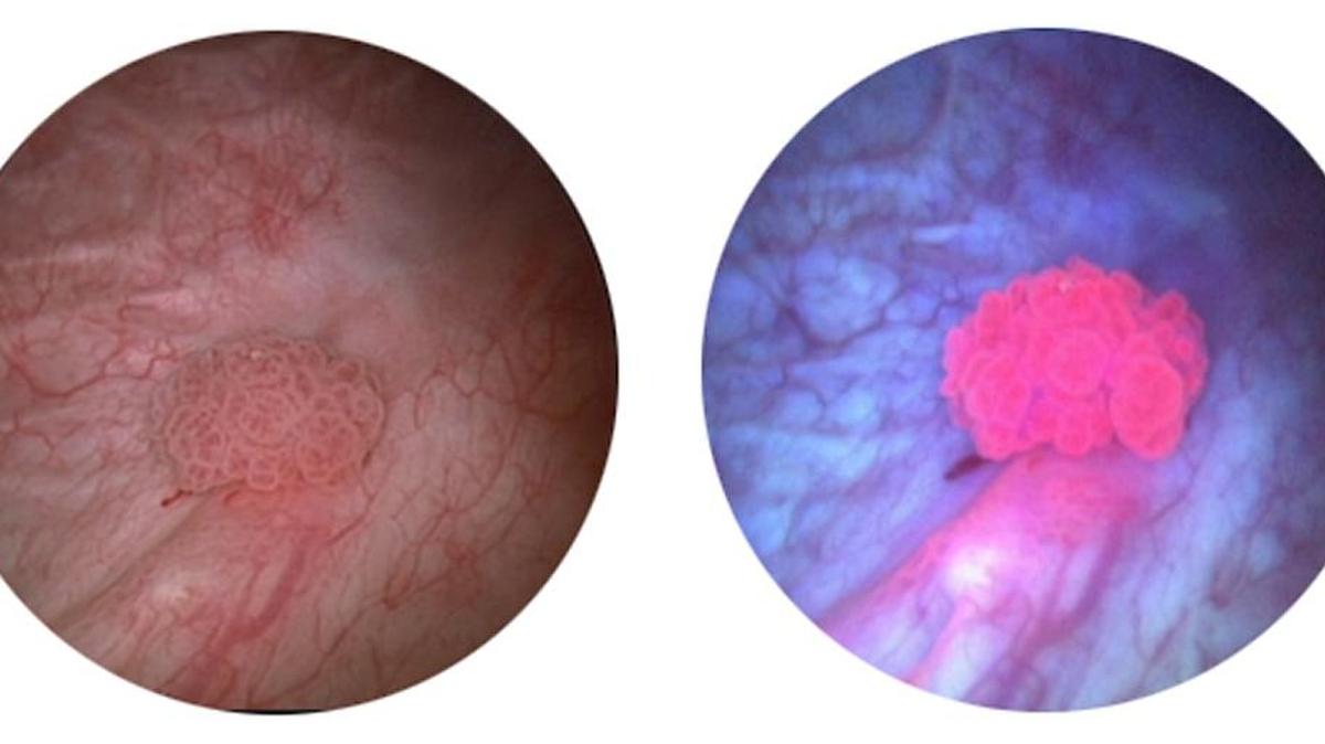La cistoscopia llamada Blue Light Cystoscopy con Cysview®, tiñe las células cancerígenas de color rojo, de manera que las hace más visibles.