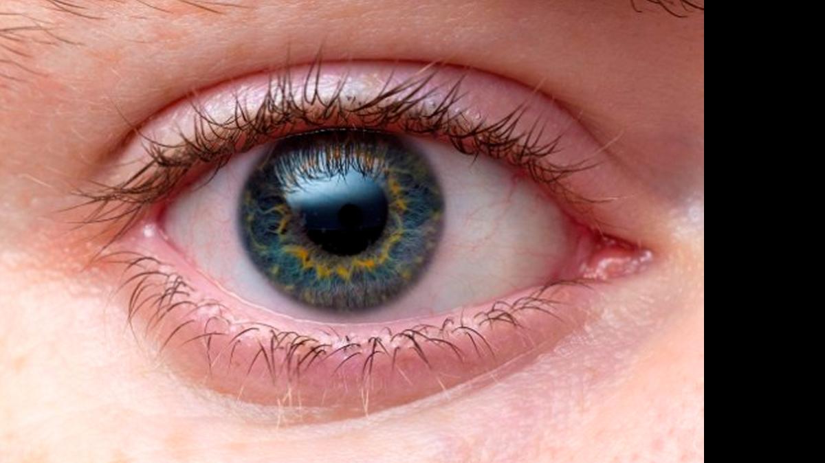 
Una abrasión de la córnea puede suceder cuando el ojo es golpeado, frotado con un objeto extraño o si entra un cuerpo extraño en el ojo. 
